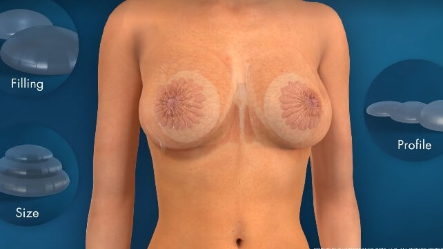 Anatomy of Breast Implants Sur